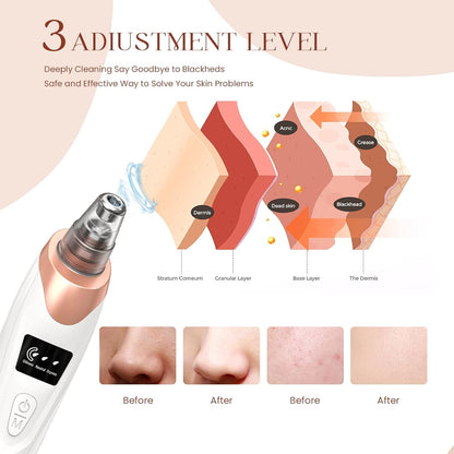 2026 Blackhead Remover Vacuum – USB Rechargeable Pore Cleaner with 5 Suction Levels & 5 Probes
